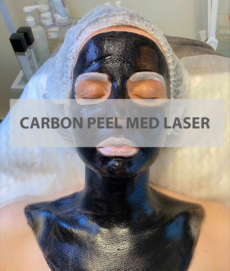 Carbon Laser Peeling